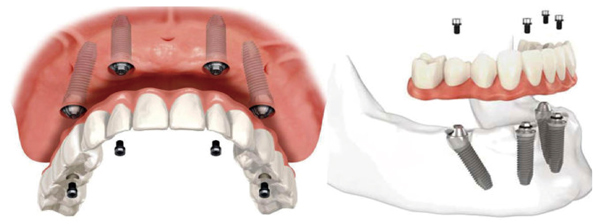 All-on-4种植牙