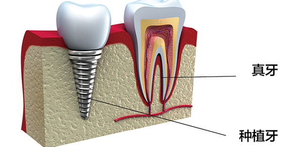 真牙与种植牙对比图
