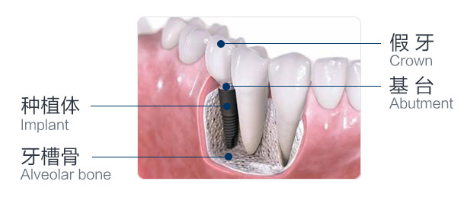 种植牙示意图—苏州美奥口腔