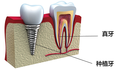 种植牙剖面图-苏州美奥口腔